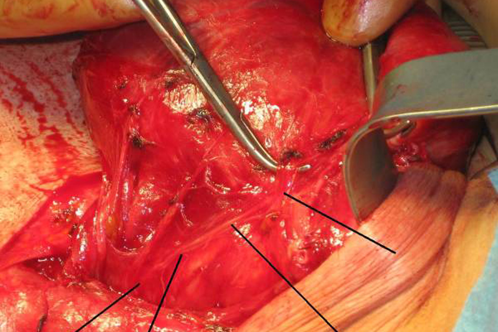 Nervus recurrens links -mit Pfeilen markiert